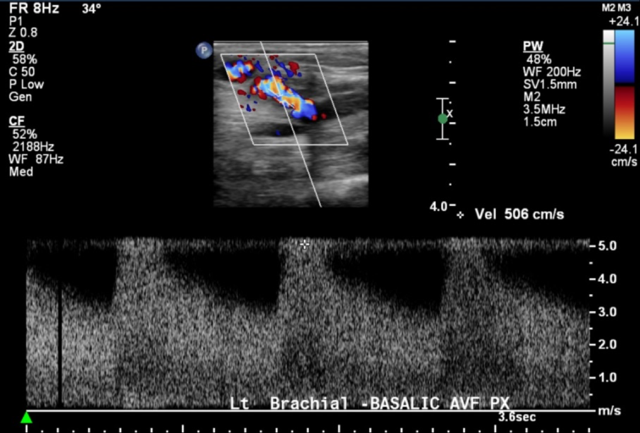 Case 3 Ultrasound | Hemodialysis Access 101